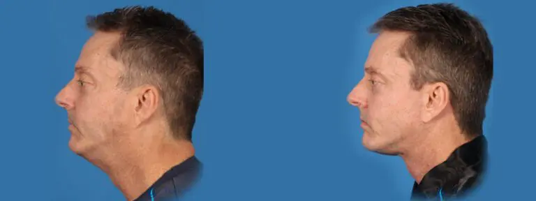 Face Lift