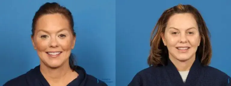 Face Lift