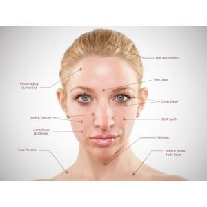 Microneedling
