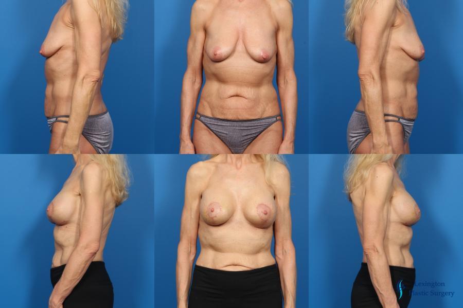 Breast Augmentation With Lift: Patient 3 Breast Augmentation With Lift: Patient 3