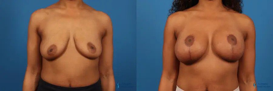 Breast Augmentation With Lift: Patient 4 Breast Augmentation With Lift: Patient 4
