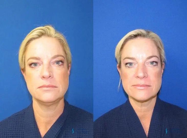 Kybella: Patient 1