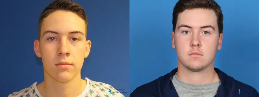 Otoplasty: Patient 1