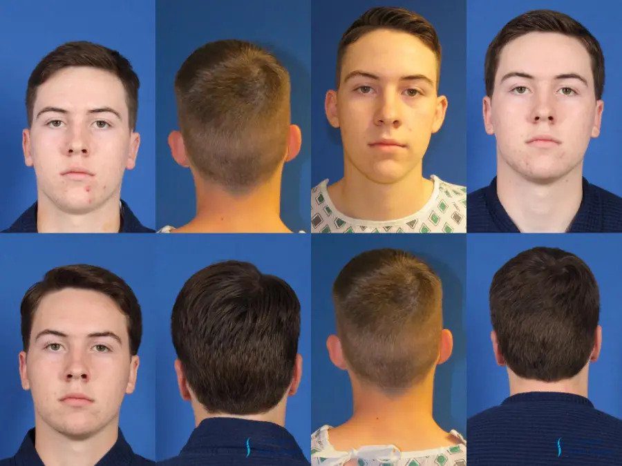 Otoplasty: Patient 2 Otoplasty: Patient 2