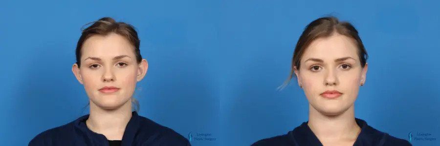 Otoplasty: Patient 3 Otoplasty: Patient 3