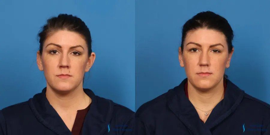 Otoplasty: Patient 4 Otoplasty: Patient 4