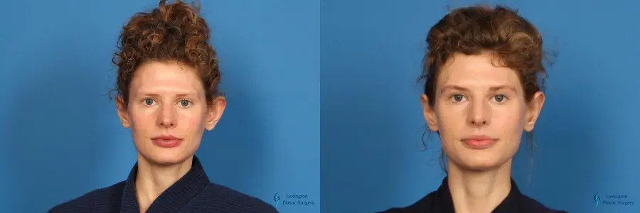 Otoplasty: Patient 5 Otoplasty: Patient 5