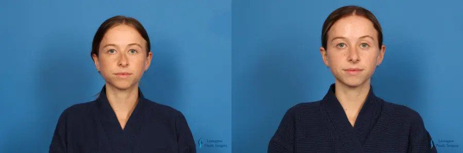 Rhinoplasty: Patient 2 Rhinoplasty: Patient 2