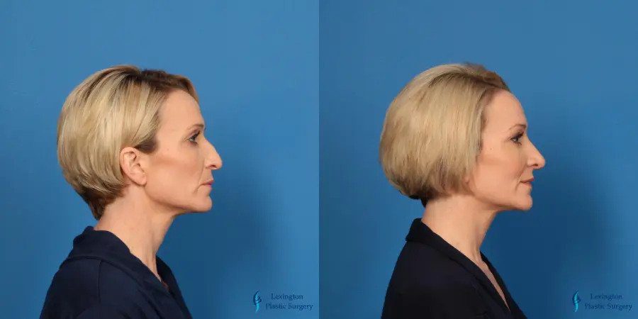 Rhinoplasty - Revision: Patient 1
