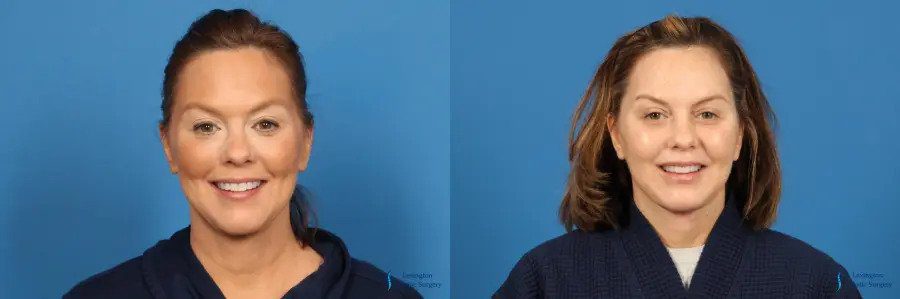 Facelift: Patient 2 Facelift: Patient 2