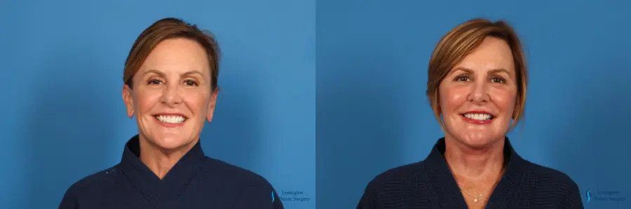 Facelift: Patient 3 Facelift: Patient 3