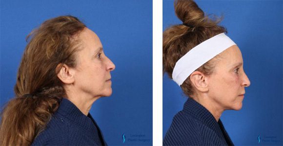 Fat Transfer Face: Patient 1