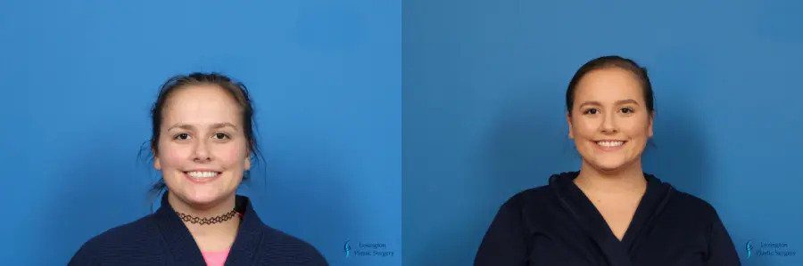 Lip Filler: Patient 2 Lip Filler: Patient 2