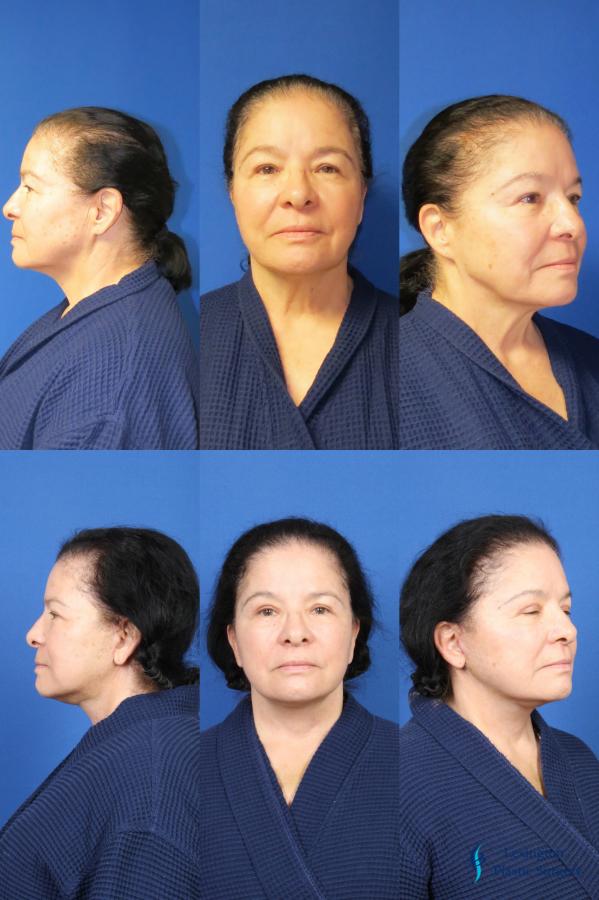 Facelift & Neck Lift: Patient 1