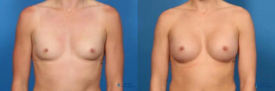 Breast Augmentation: Patient 10 Breast Augmentation: Patient 10