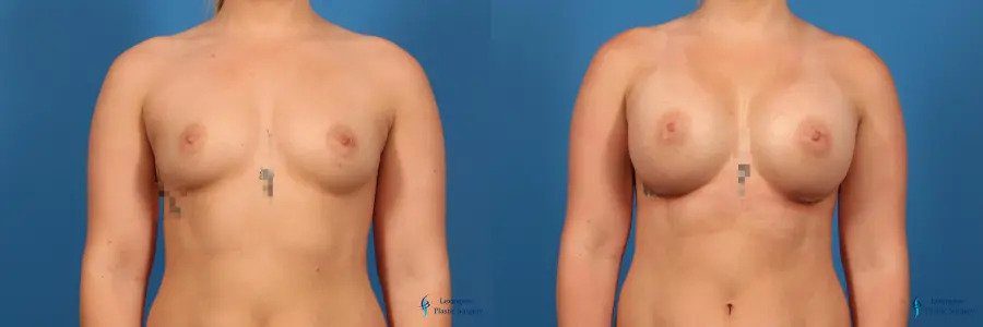 Breast Augmentation: Patient 12 Breast Augmentation: Patient 12