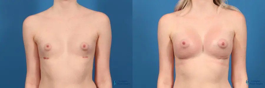 Breast Augmentation: Patient 13 Breast Augmentation: Patient 13