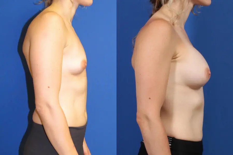 Breast Augmentation: Patient 2