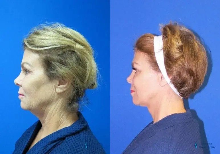 Facelift & Neck Lift: Patient 2