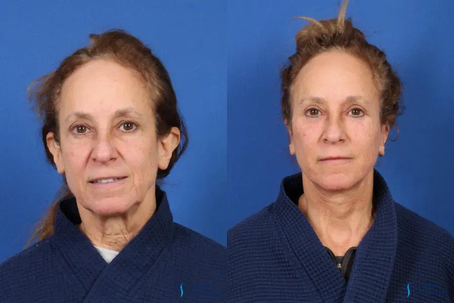 Facelift & Neck Lift: Patient 3 Facelift & Neck Lift: Patient 3