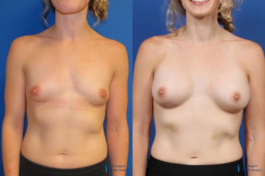 Breast Augmentation: Patient 4 Breast Augmentation: Patient 4