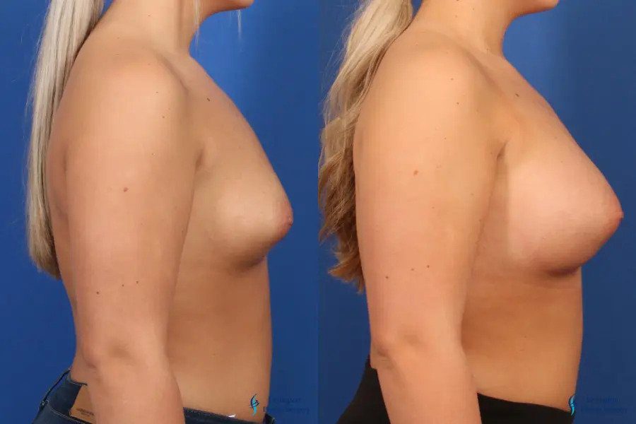 Breast Augmentation: Patient 6 Breast Augmentation: Patient 6