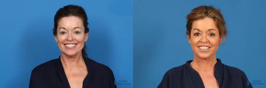 Neck Lift: Patient 1