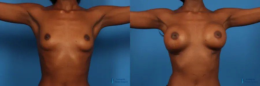 Breast Augmentation: Patient 9 Breast Augmentation: Patient 9