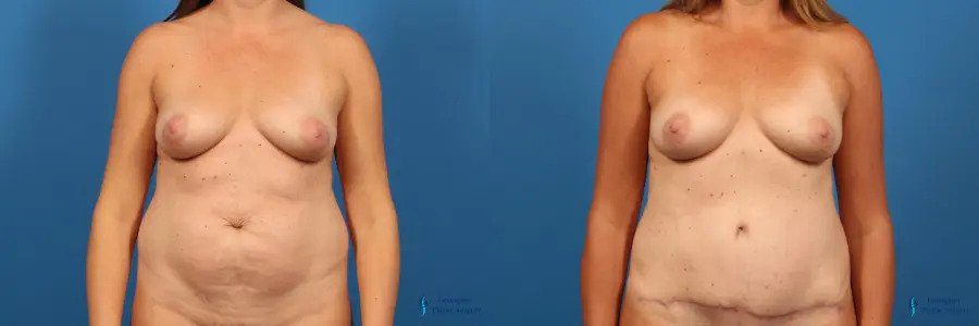 Abdominoplasty: Patient 7 Abdominoplasty: Patient 7