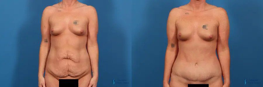 Abdominoplasty: Patient 9 Abdominoplasty: Patient 9