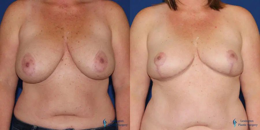 Breast Reduction: Patient 3 Breast Reduction: Patient 3