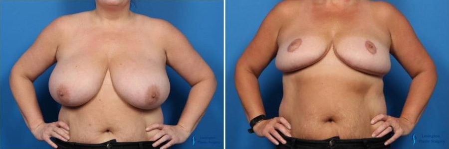 Breast Reduction: Patient 4 Breast Reduction: Patient 4