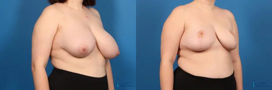 Breast Reduction: Patient 5 Breast Reduction: Patient 5