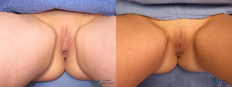 Labiaplasty: Patient 14