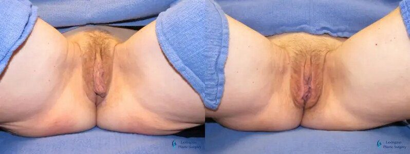 Labiaplasty: Patient 15