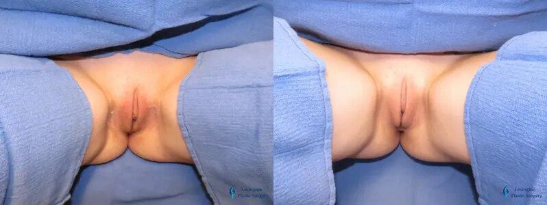 Labiaplasty: Patient 16