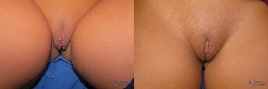 Ear Surgery Patient 2