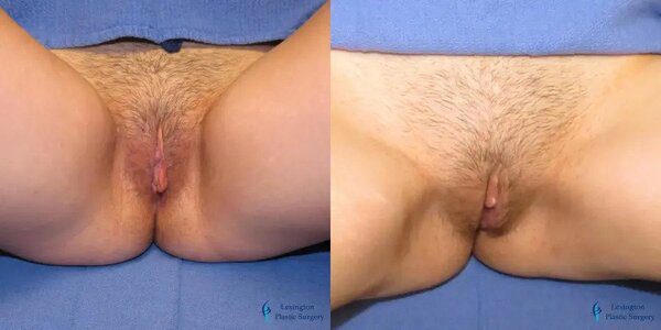 Labiaplasty: Patient 6