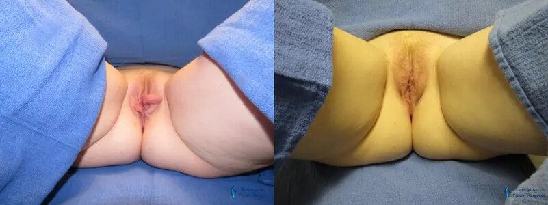 Labiaplasty: Patient 8