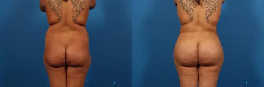 Liposuction: Patient 1