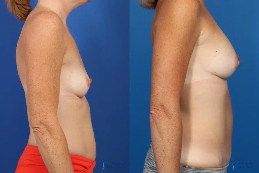 Mommy Makeover: Patient 1