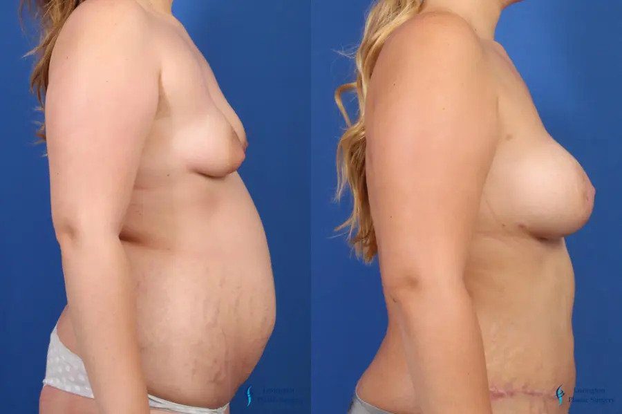 Mommy Makeover: Patient 2 Mommy Makeover: Patient 2