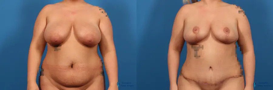 Mommy Makeover: Patient 5 Mommy Makeover: Patient 5