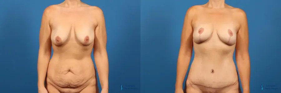 Mommy Makeover: Patient 6 Mommy Makeover: Patient 6