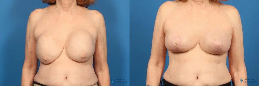 Breast Implant Removal With Lift: Patient 2