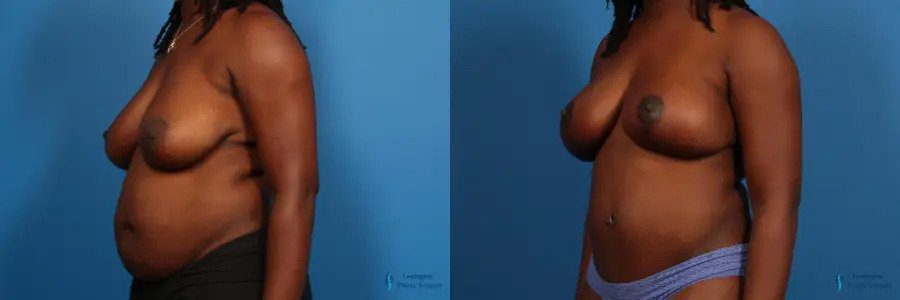 Breast Lift: Patient 4