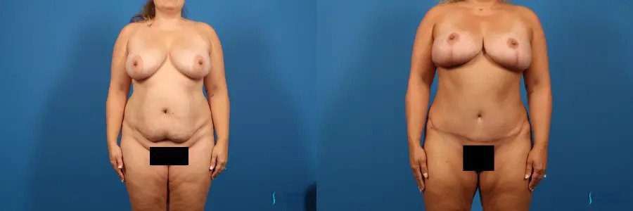 Breast Lift: Patient 5