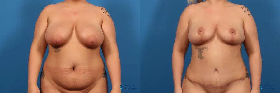 Breast Lift: Patient 6