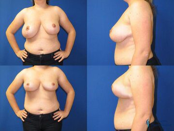 Breast Reduction: Patient 1