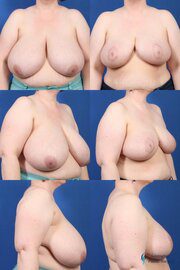 breast-reduction-patient-2 Breast Reduction: Patient 2
